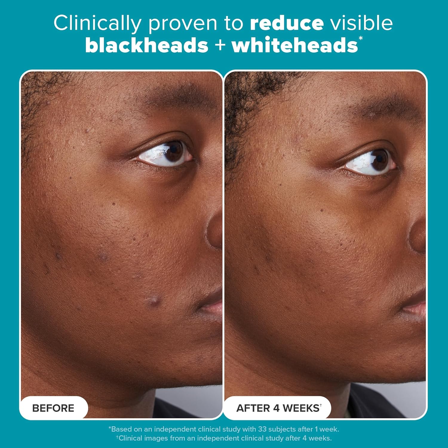 Paula's Choice SKIN PERFECTING 2% BHA Liquid Salicylic Acid Exfoliant-Facial Exfoliant for Blackheads, Enlarged Pores, Wrinkles & Fine Lines 24hrsmart